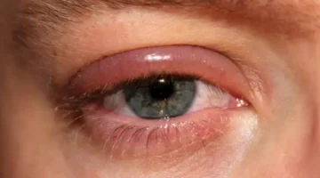 أعراض وأسباب غير شائعة لالتهابات جفن العين